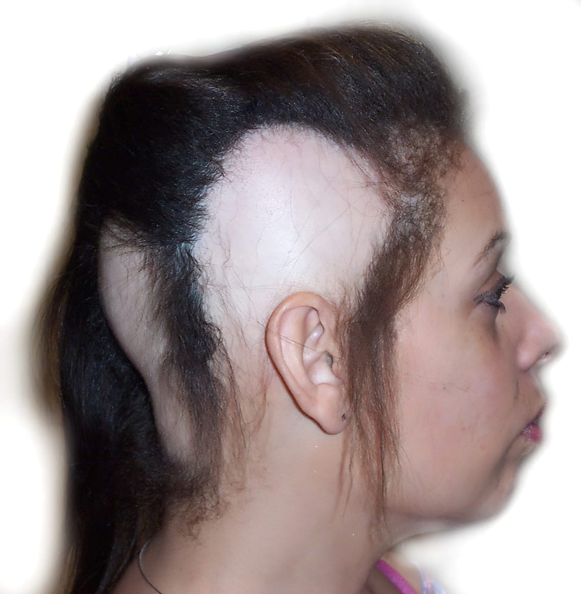 Before Picture - Alopecia Areata
